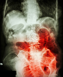 小肠梗阻 腹部仰卧 X 光片 显示小肠因小肠梗阻而扩张病人药品身体梗阻医院疾病卫生手术男人保健图片