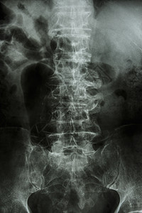 胶片X射线 腰脊椎 有刺激和崩溃解剖学药品脊柱椎骨射线衰老恶化弯曲疾病治疗图片