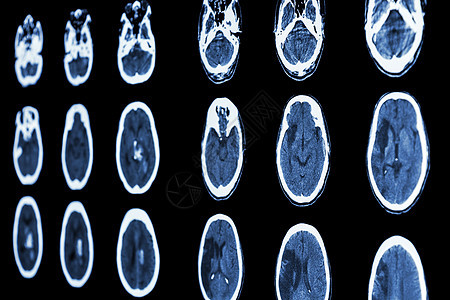 脑显示化学中风缺血和出血的薄膜CT扫描断层神经事故保健科学放射科医院诊断颅骨射线图片