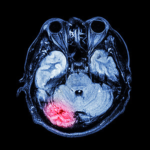 MRI 大脑 显示大脑的下部部分小脑 时空叶筛骨碰撞男人手术医院颅骨放射科扫描药品x射线图片