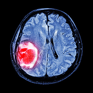 MRI 大脑 显示脑部右皮层叶的脑肿瘤治疗麻痹电影卫生射线病人医生保健外科x射线图片