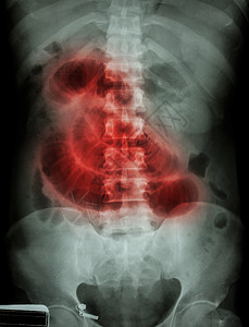 电影X射线腹部膜 显示Show放射科骨盆椎骨医生肠胃外科解剖学病人诊断身体图片