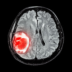 MRI 大脑 显示脑部右皮层叶的脑肿瘤治疗癌症电影外科医院男人卫生肿瘤疾病射线图片