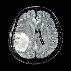 MRI 大脑 显示脑部右皮层叶的脑肿瘤解剖学卫生诊断颅骨癌症保健病人疾病外科治疗图片