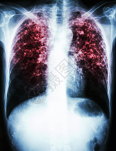 结核分枝杆菌感染 肺结核结核病卫生感染科学药品胸部结核蓝色x射线诊断图片