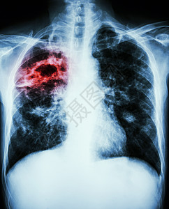 结核分枝杆菌感染 肺结核电影蓝色结核病x射线保健诊断骨骼放射科医院结核图片