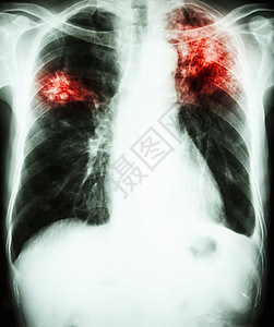 肺炎肺结核疾病胸部放射科骨骼医院医生药品科学x射线诊断图片
