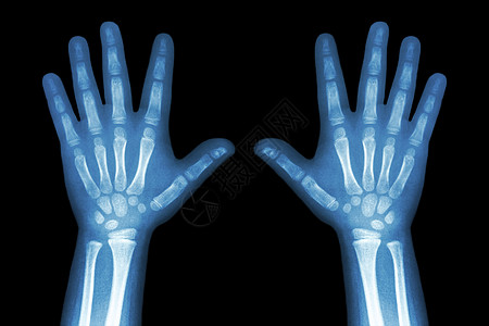 黑背景的两只儿童手X光儿科前臂医院生物学半径外科棕榈放射科手指骨科图片