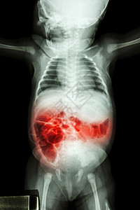 肠炎对生病婴儿的X光和肠炎儿科放射科孩子新生儿x光器官解剖学疾病卫生病人图片