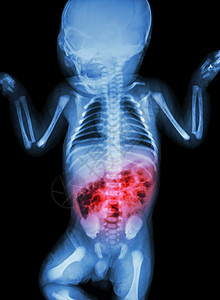 肠炎对生病婴儿的X光和肠炎卫生腹痛医生疾病x射线解剖学新生儿器官医院肠胃图片