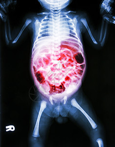肠炎对生病婴儿的X光和肠炎身体疾病医生解剖学骨骼腹痛保健肠胃器官x射线图片