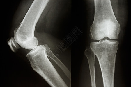 正常膝关节图片