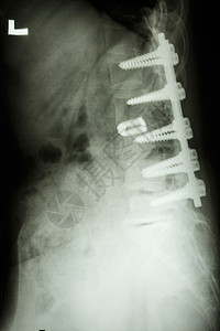 腰脊椎结冰球螺丝固定骨骼医师放射科保健药品病人诊所创伤治疗外科图片
