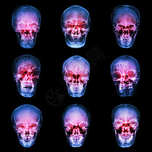 收集亚洲人头骨疾病射线卫生x射线事故目录诊断外科扫描病人图片