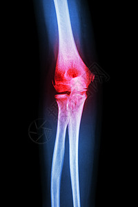 X射线人肘部和关节炎淋病 风湿保健蓝色x光诊断疾病骨科创伤卫生x射线医生图片