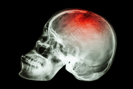 X射线头骨平面与Stroke放射科脑血管中风犯罪颅骨死亡疾病事故扫描外科图片