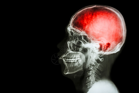 X射线头骨和子宫颈脊椎附带与Strokex光脊柱男人脑血管药品身体大脑颈椎病事故蓝色图片