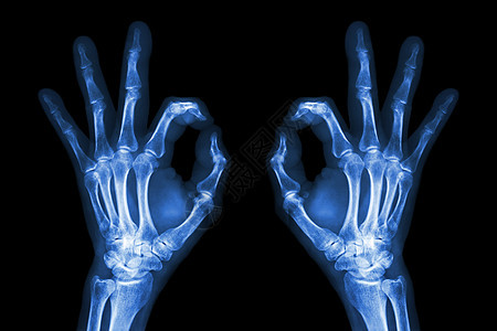 X光手带确定符号x光解剖学放射科药品疾病临床手指射线手臂x射线图片