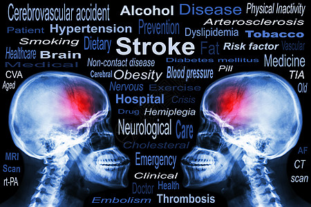 X射线Skull 带有Stroke和医疗文本脖子医院药品收藏插图脊柱射线临床脑血管x射线图片