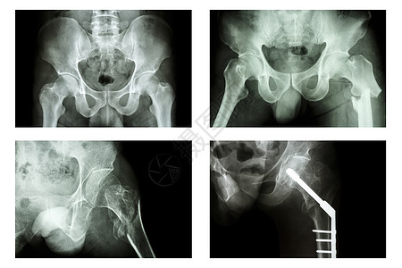 X射线薄膜骨折股骨(高处骨骨) 是手术和内部固定骨骼背景图片