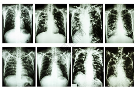 收集胸部X射线“肺肺结核”图片