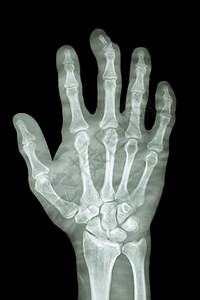 中指断裂折断的中间手指方形诊断x射线碰撞病人骨科男人射线腕骨解剖学情况图片