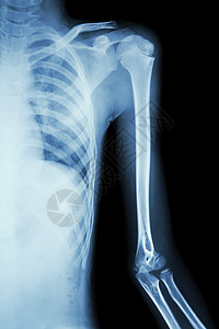 左肩左侧X射线胶片手臂扫描射线治疗医生肱骨诊断胸部身体肩膀图片