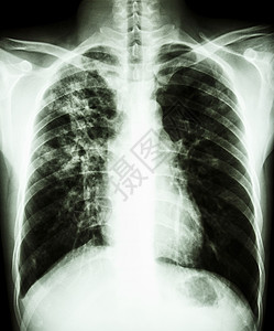 肺结核电影结核医院身体空气药品解剖学卫生诊断结核病图片