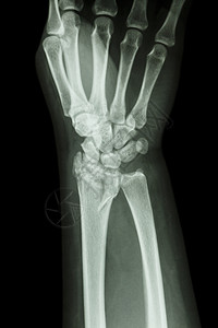 骨折断裂分半径前臂骨手指腕骨射线诊断x射线药品骨科痛苦前臂解剖学图片