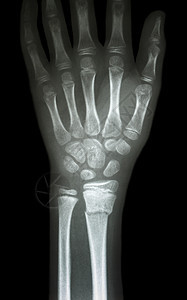 骨折断裂分半径前臂骨射线医生疼痛保健手臂卫生药品身体前臂x射线图片