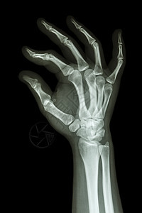人类的手和确定符号医院x射线男人卫生科学手腕保健手指射线腕骨图片
