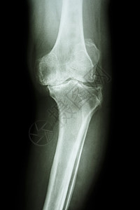 膝膝关节炎病人考试保健卫生大腿腓骨射线疼痛放射科骨科衰老图片