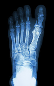 初脚趾叶质骨折近十进方正扬格保健骨骼解剖学法郎骨科跗骨考试蓝色x射线疼痛图片