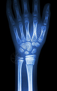 骨折断裂分半径前臂骨手术腕骨扫描卫生骨科保健男人数字药品诊断图片