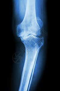 膝膝关节炎病人腓骨医院骨科股骨衰老扫描医生考试骨骼解剖学图片