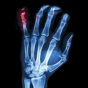 小手指骨折 断裂数字疾病外科蓝色手术诊断医院手腕棕榈创伤图片