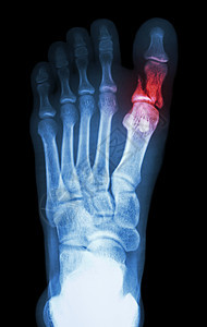 初脚趾叶质骨折近十进方正扬格医院解剖学保健考试疾病拇指骨骼情况创伤射线图片