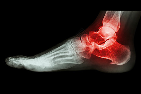 X光人脚踝关节炎卫生男人射线创伤痛风医生风湿药品关节炎医院图片