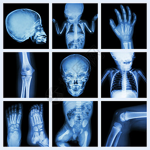 儿童身体的X光部分第2版手术情况新生外科画廊扫描儿科收藏疾病解剖学图片