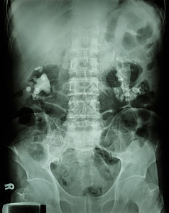 双边肾上钙角药品外科射线泌尿科诊断空白病人系统肾脏脊柱图片