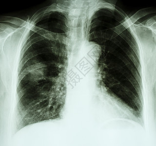 肺癌病人X光胸图片