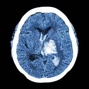 CT大脑 显示左脑出血出血中风神经中风诊断保健医生x射线电脑脑血管射线外科图片