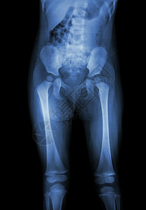 儿童 X 光片正常身体 腹部 臀部 大腿 膝盖骨盆腰部电影医生诊断疾病婴儿胫骨屁股脊柱图片
