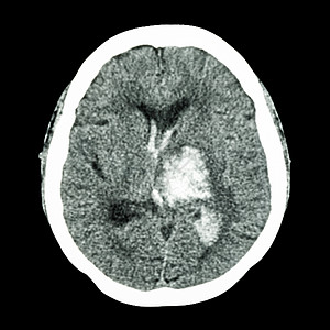 CT大脑 显示左脑出血出血中风病人放射科科学诊断外科卫生疾病扫描断层神经图片