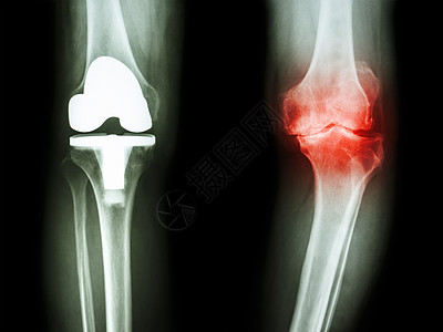 骨眼关节炎病人和人工关节的膝部腓骨骨科胫骨药品医院衰老外科金属疾病股骨图片