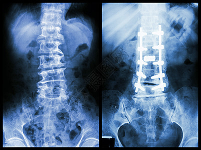 脊髓硬化左侧图象 病人手术和内部固定 正确图象医生骨骼治疗射线骨科扫描药品金属腰椎x光图片