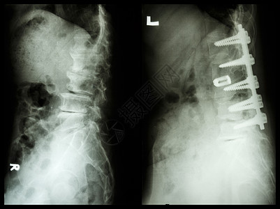 “脊椎病” 左图 患者接受了手术并进行了内固定 右图 老人“脊椎病” 左图 患者进行了手术并进行了内固定 右图 老人图片