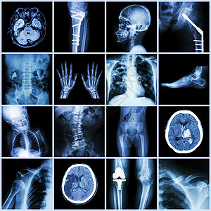 一套 X 射线人体多个部分 多种疾病 骨科 手术 中风 骨折 骨科手术 肾结石 关节炎 痛风 肺结核 心脏病 脊柱侧凸等x射线病图片