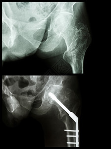 外形骨折左腿骨断裂的大腿骨 手术后插入了内指甲诊断药品解剖学骨骼射线治疗金属扫描x射线放射科图片