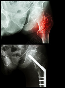 左股骨大腿骨骨折是手动操作和插入内指甲的机能断裂x光骨盆射线金属骨科医生医院骨骼外科放射科图片